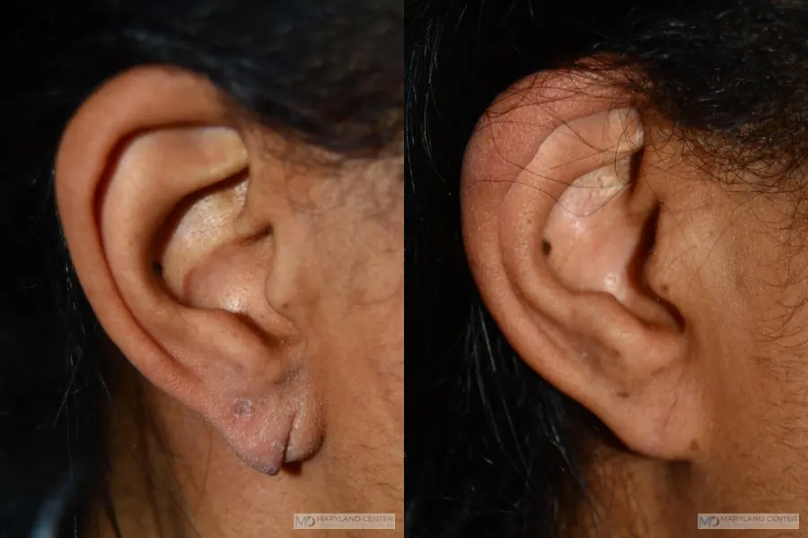 Earlobe Repair: Patient 1 - Before and After  