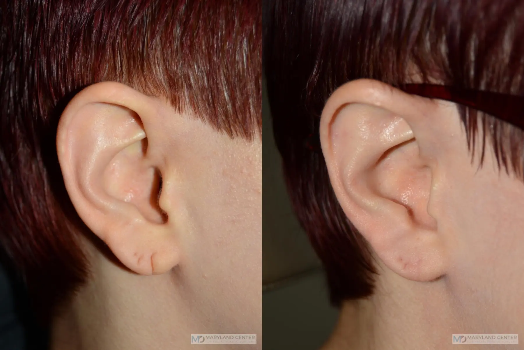 Earlobe Repair: Patient 5 - Before and After 1