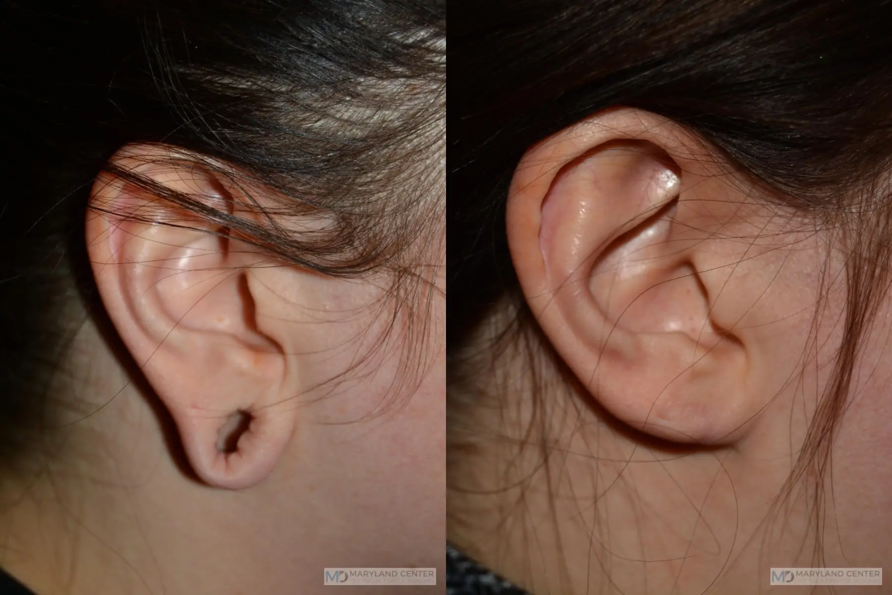 Earlobe Repair: Patient 7 - Before and After  