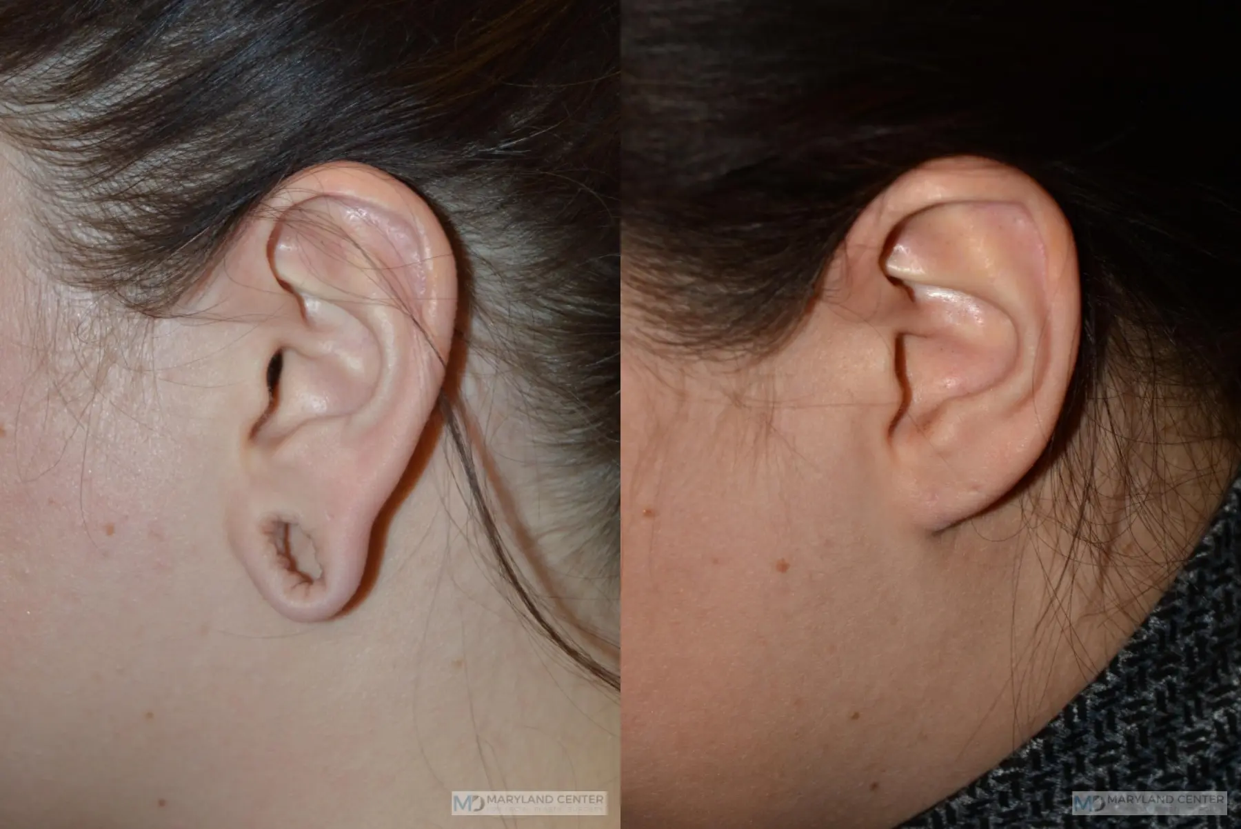 Earlobe Repair: Patient 7 - Before and After 2