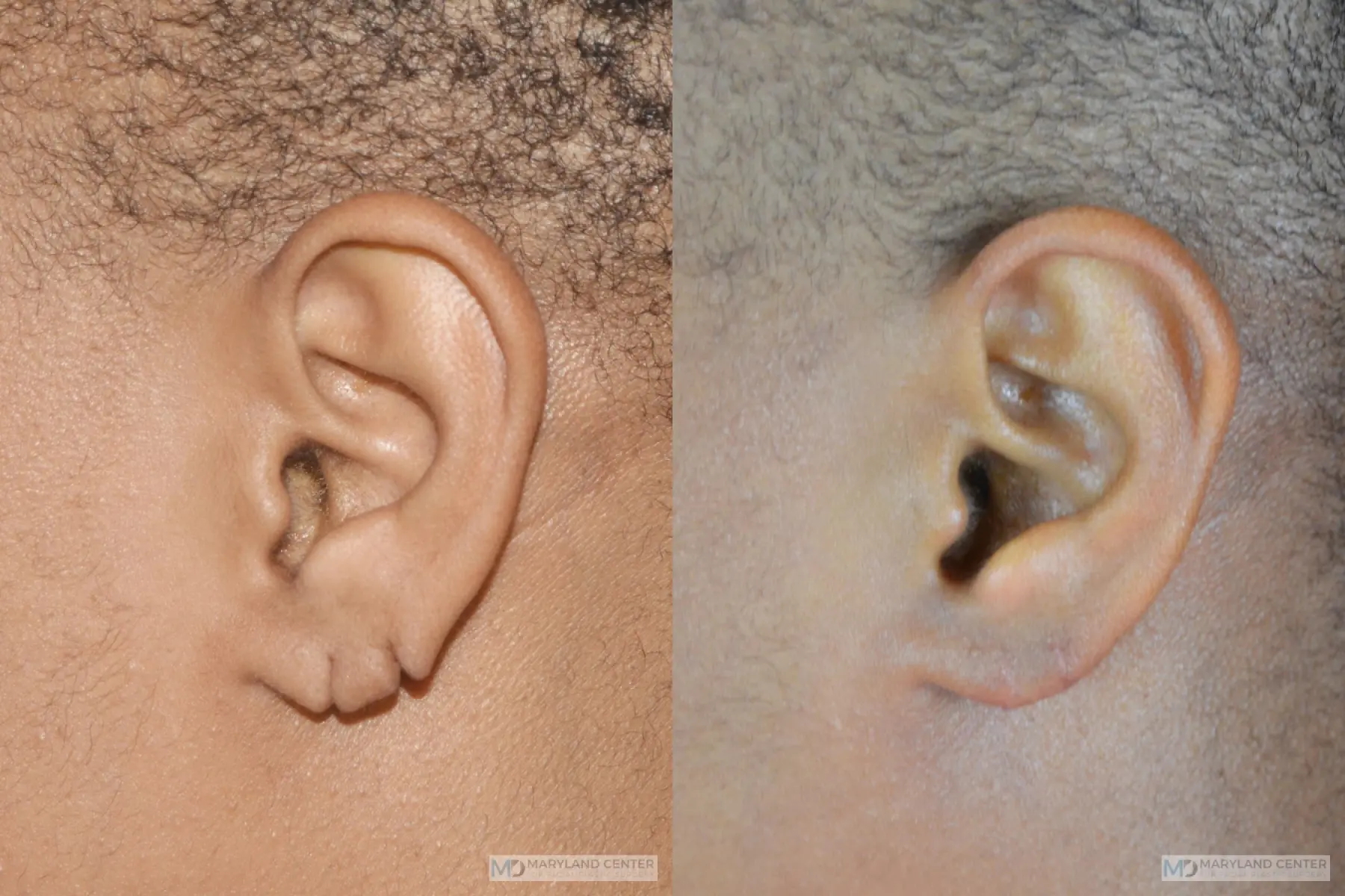 Earlobe Repair: Patient 4 - Before and After  