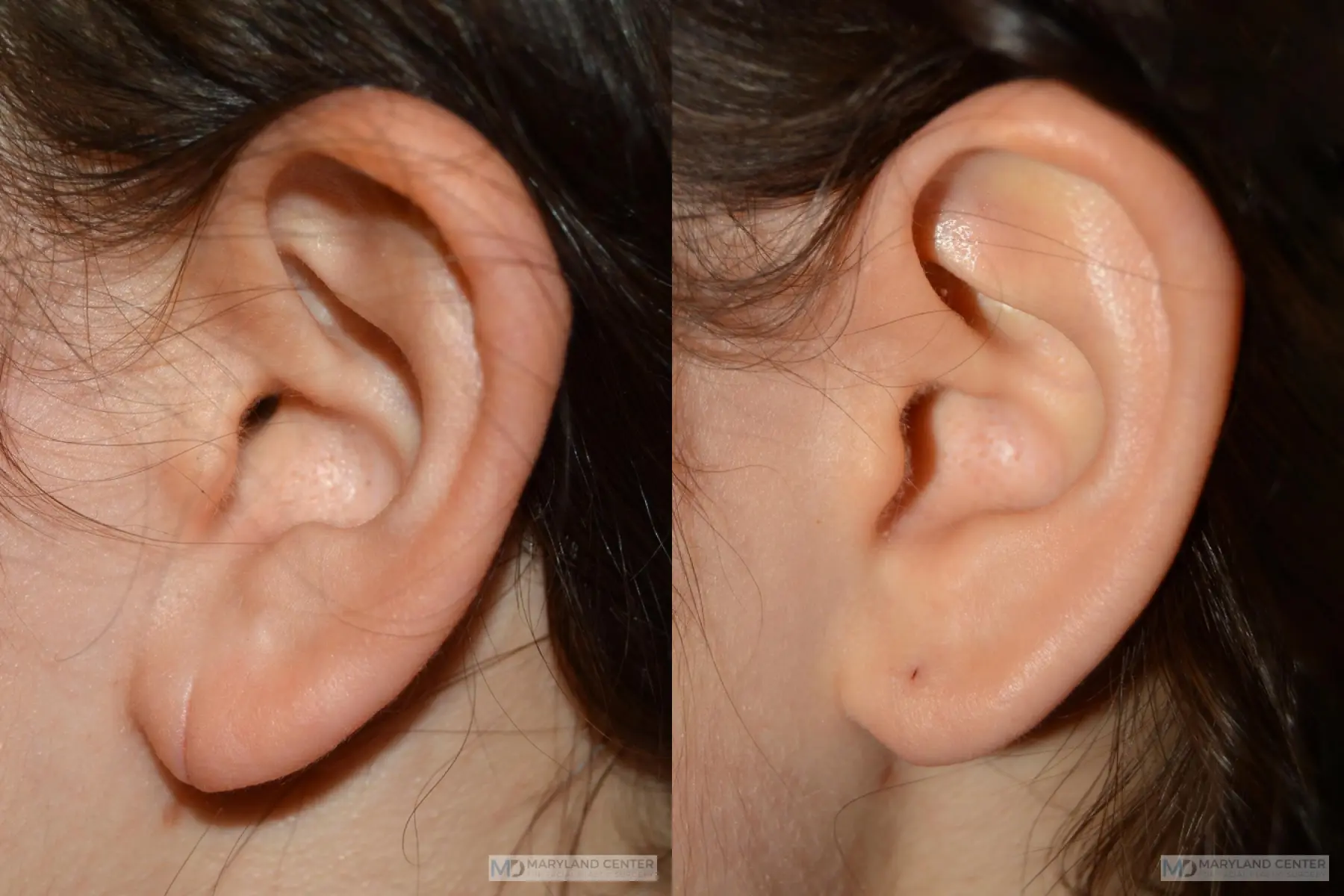 Earlobe Repair: Patient 3 - Before and After 1