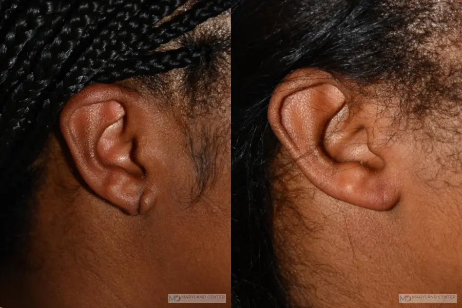 Earlobe Repair: Patient 6 - Before and After  