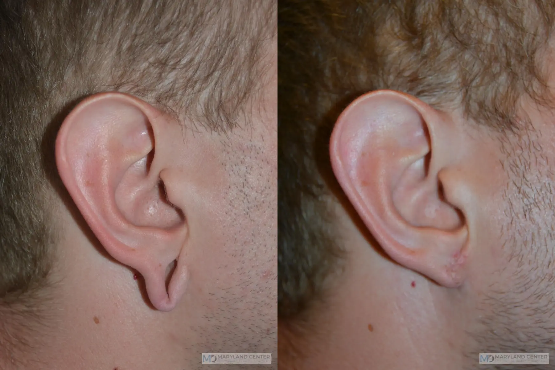 Earlobe Repair: Patient 2 - Before and After 2