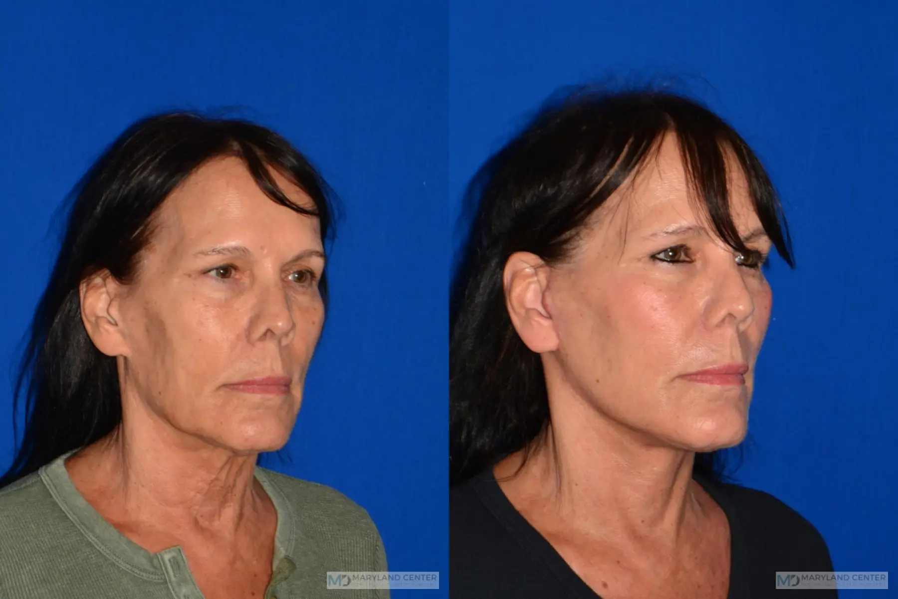 Facelift: Patient 1 - Before and After 3