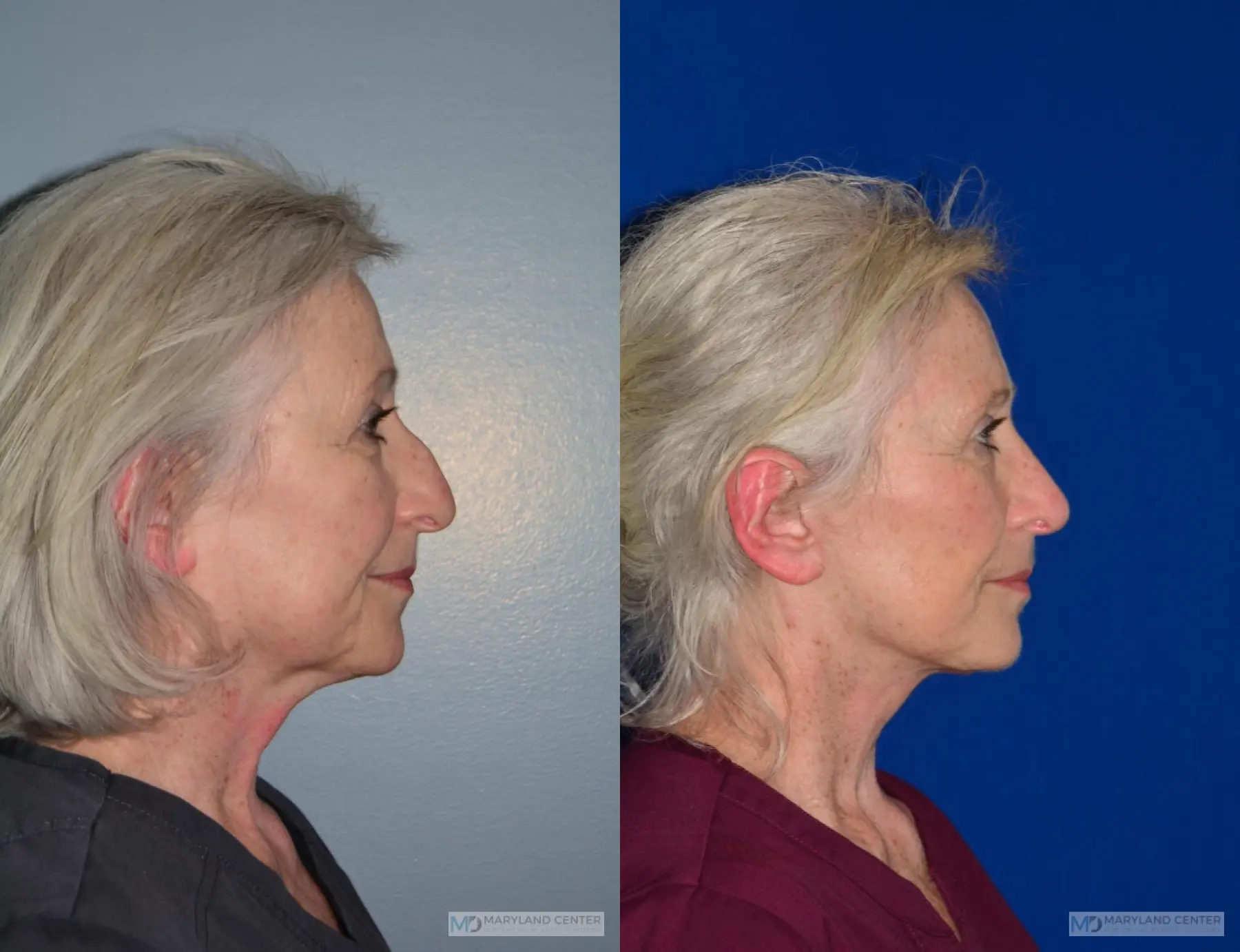 Facelift: Patient 2 - Before and After 2