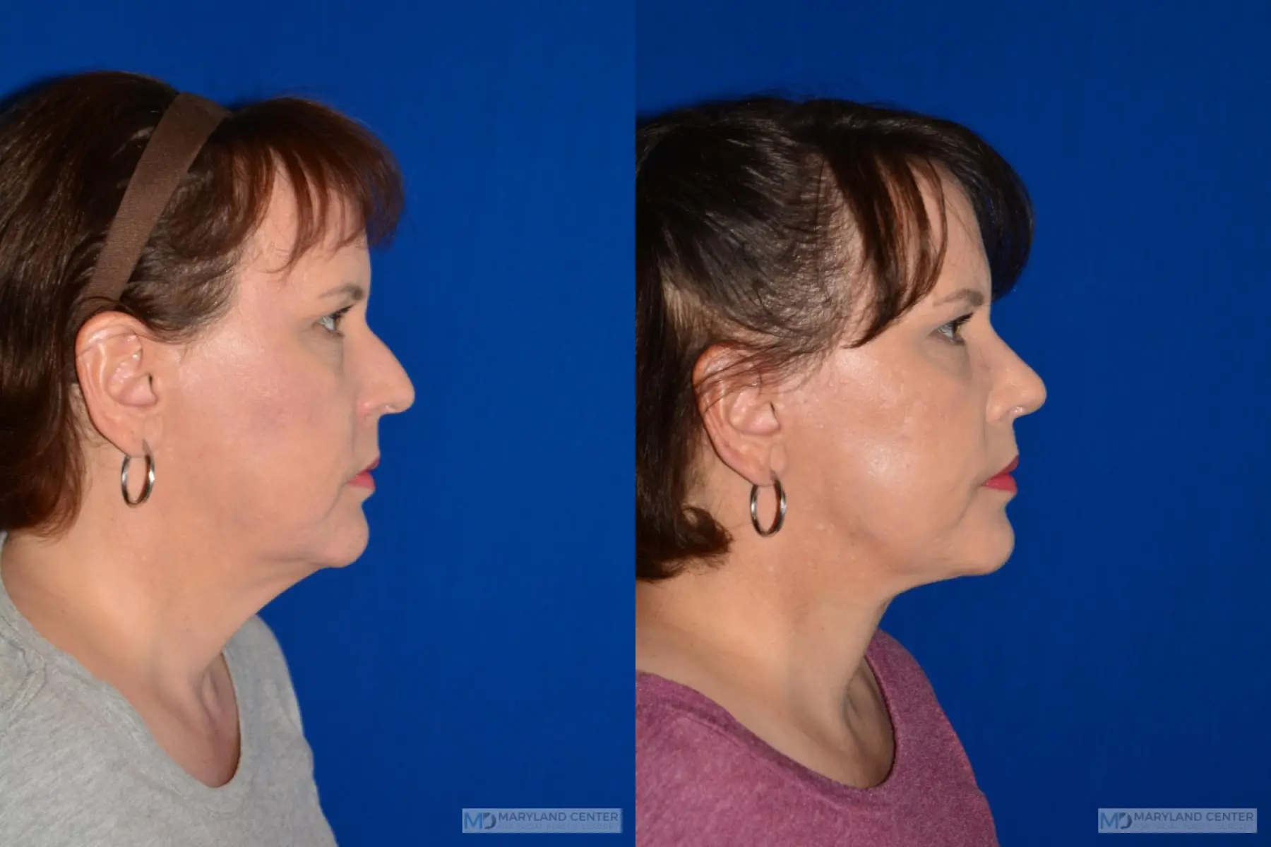Facelift: Patient 3 - Before and After 2