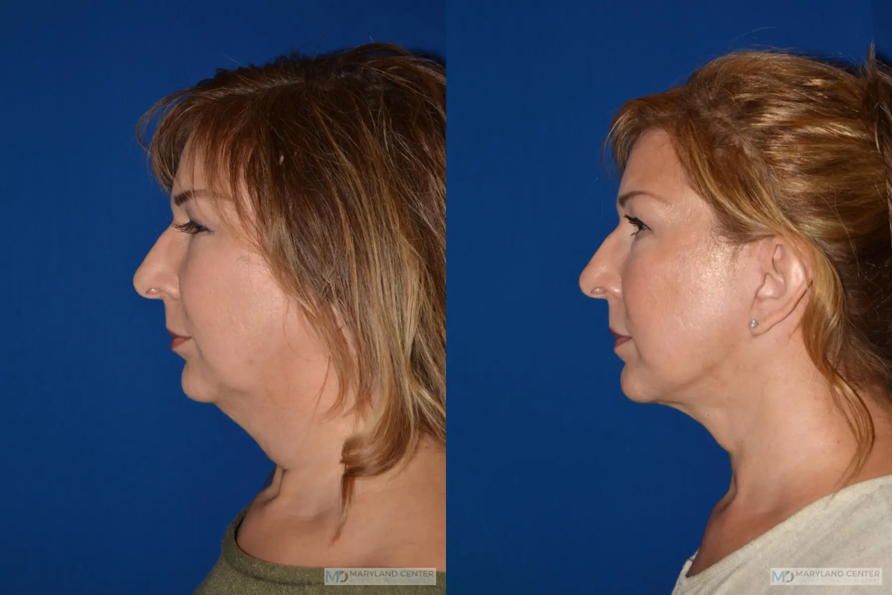 Facelift: Patient 2 - Before and After 4