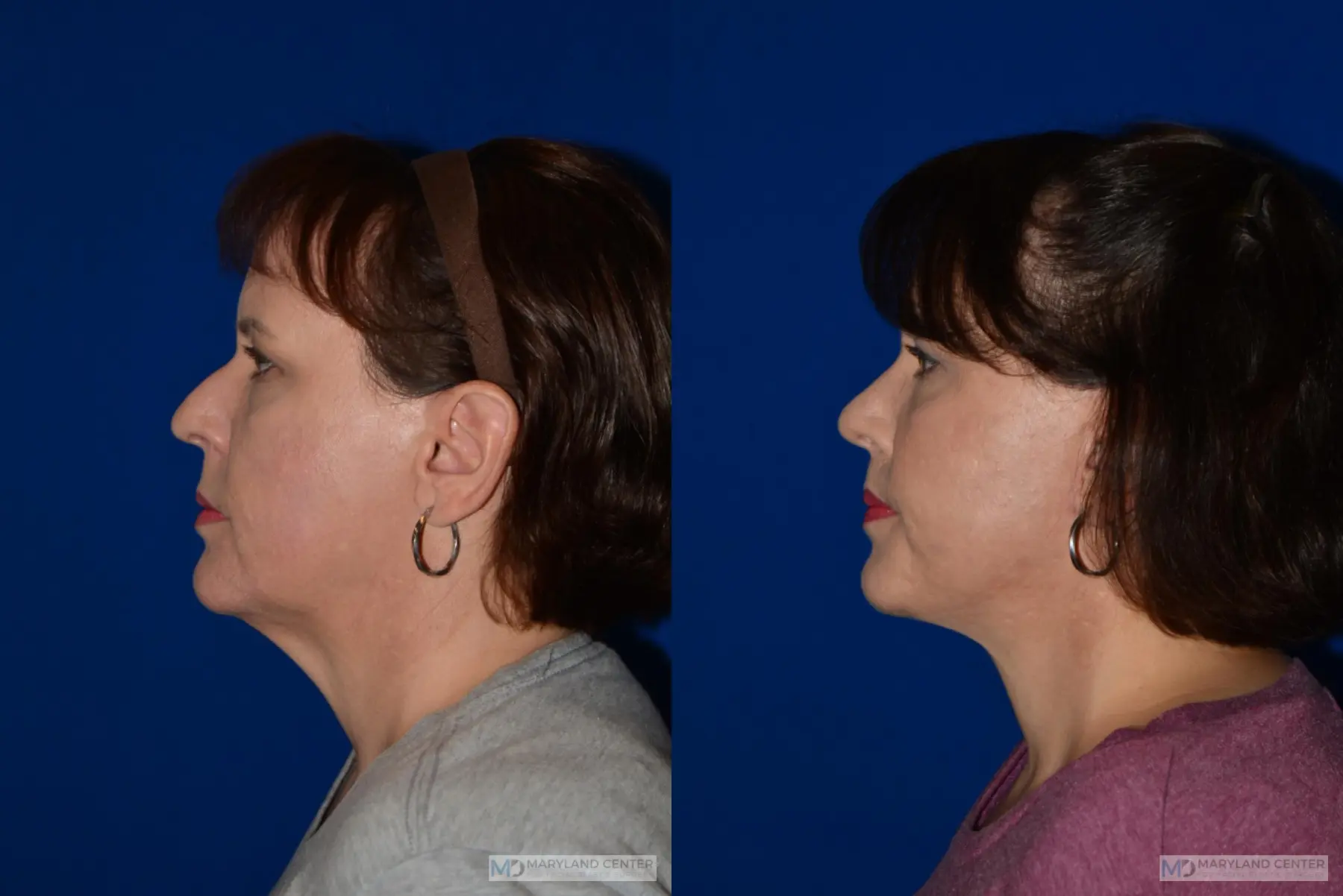 Facelift: Patient 3 - Before and After 4