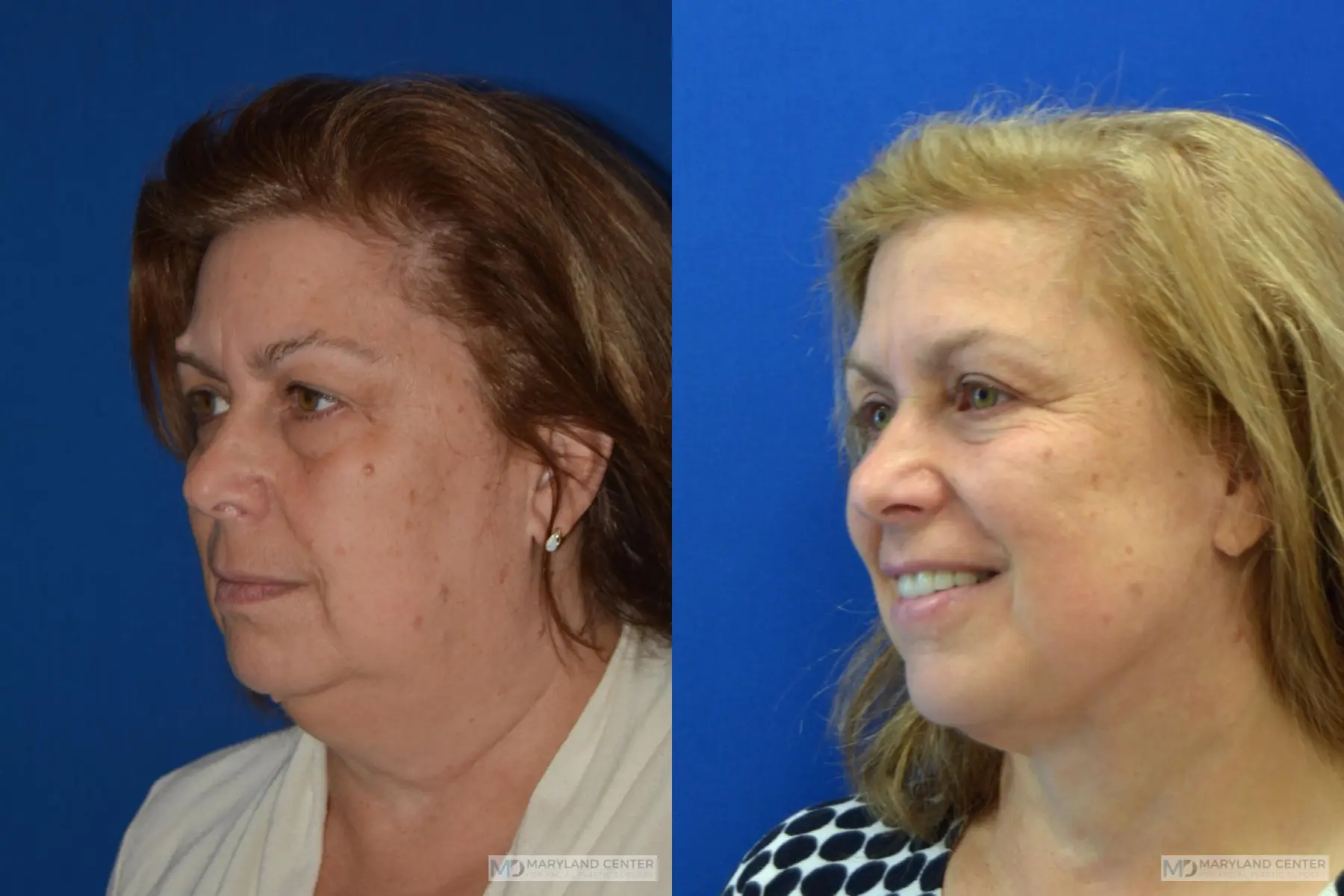 Facelift: Patient 5 - Before and After 3