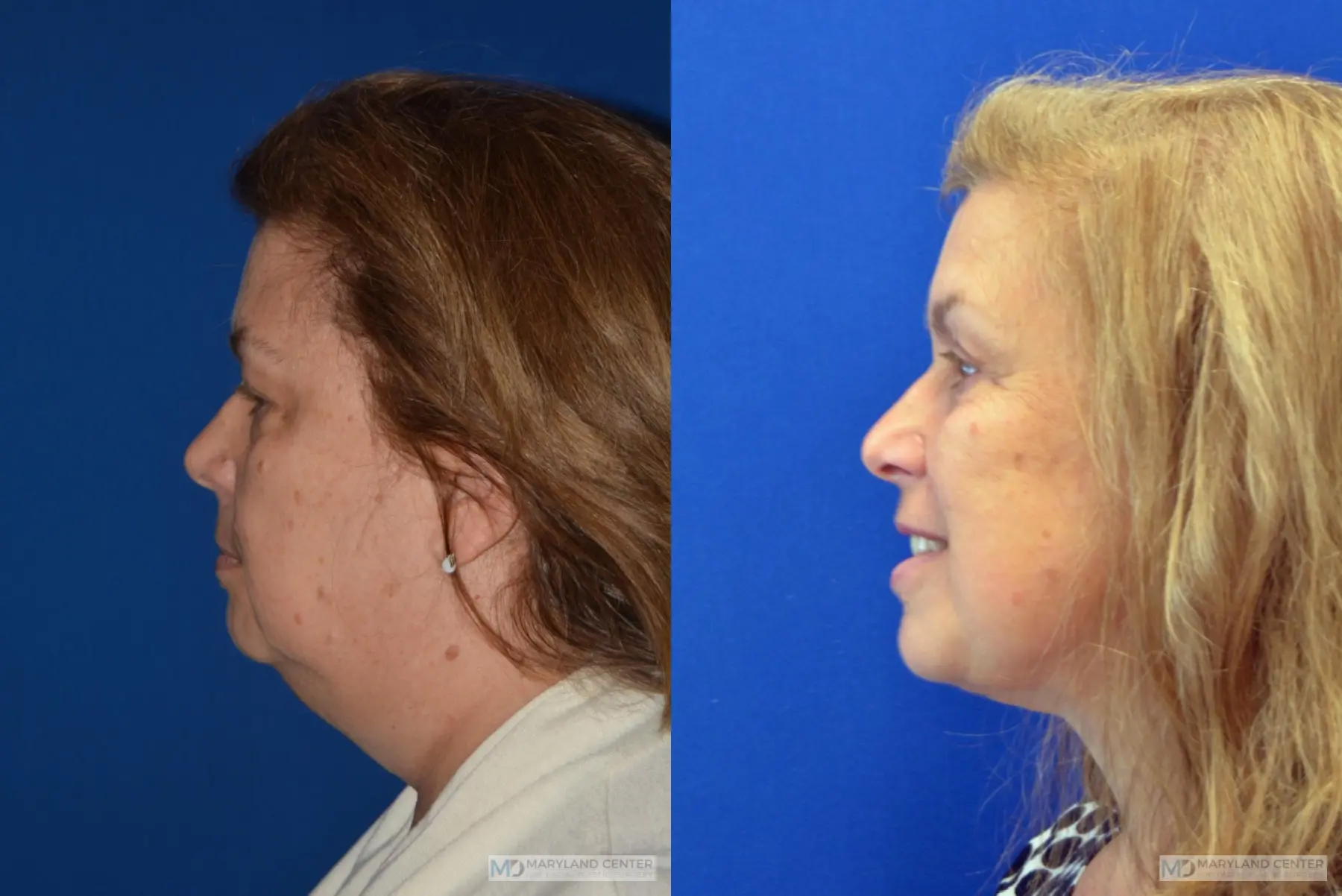 Facelift: Patient 5 - Before and After 2