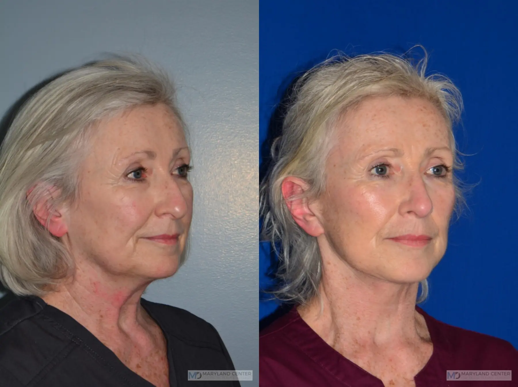 Facelift: Patient 2 - Before and After 3