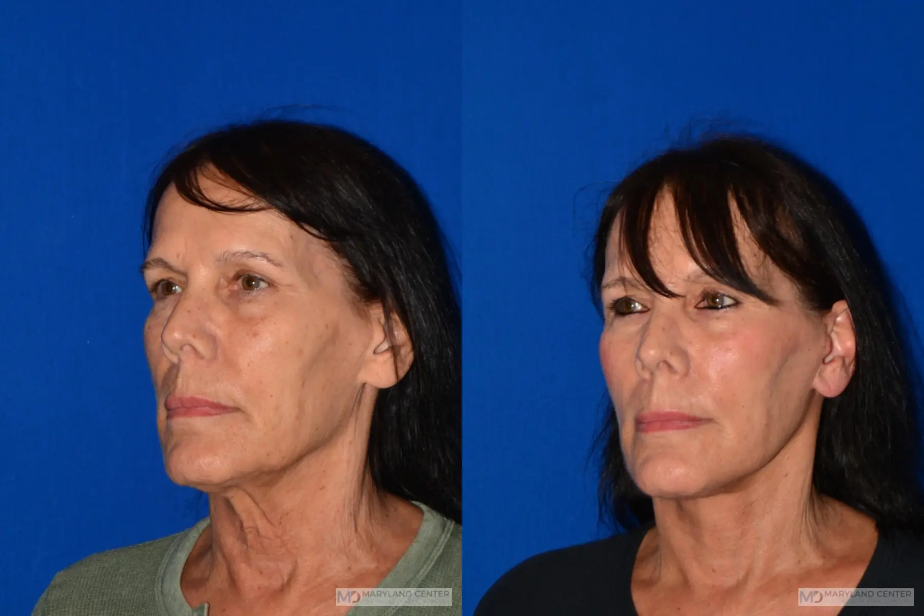 Facelift: Patient 1 - Before and After 5