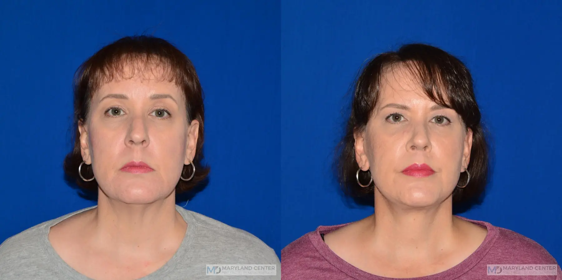 Facelift: Patient 3 - Before and After  