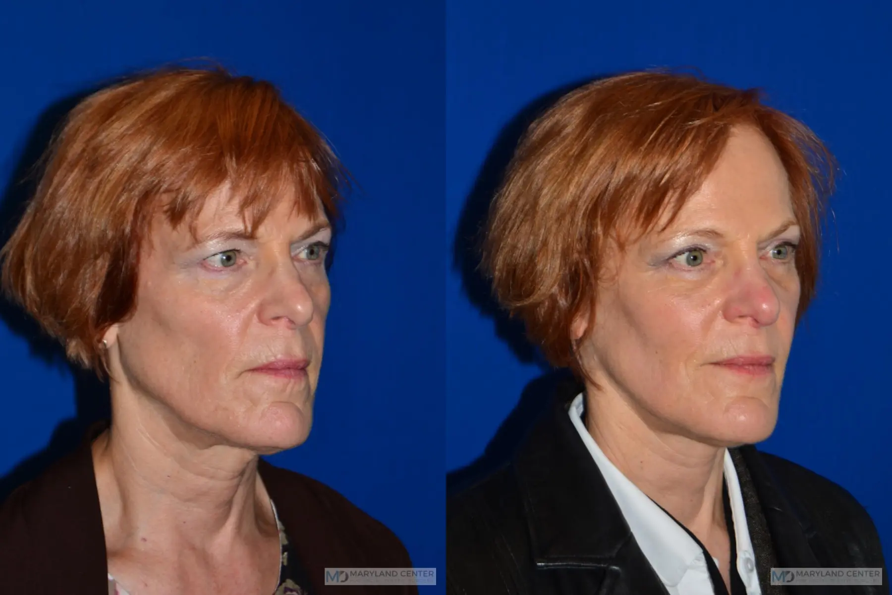 Facelift: Patient 4 - Before and After 3