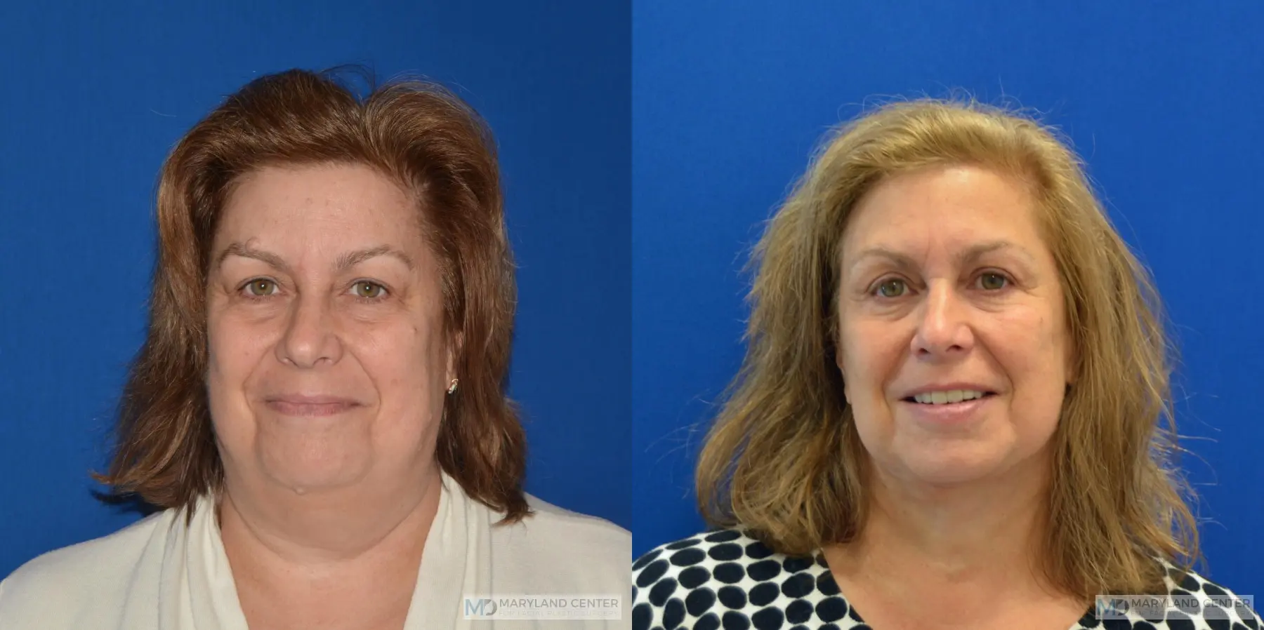 Facelift: Patient 5 - Before and After  