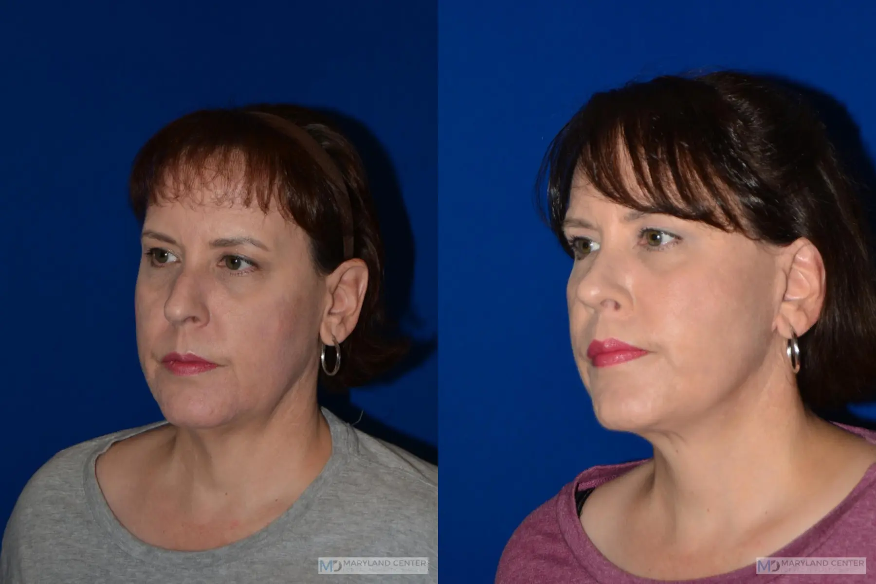 Facelift: Patient 3 - Before and After 5