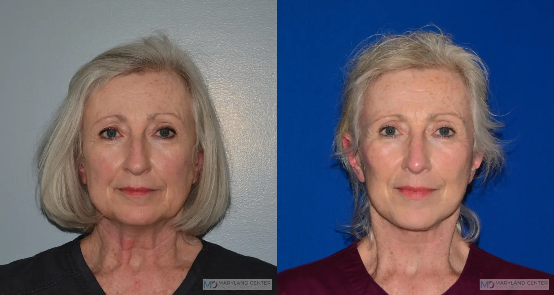 Facelift: Patient 2 - Before and After  