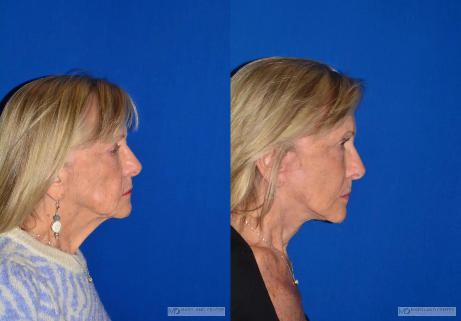 Facelift: Patient 3 - Before and After 2