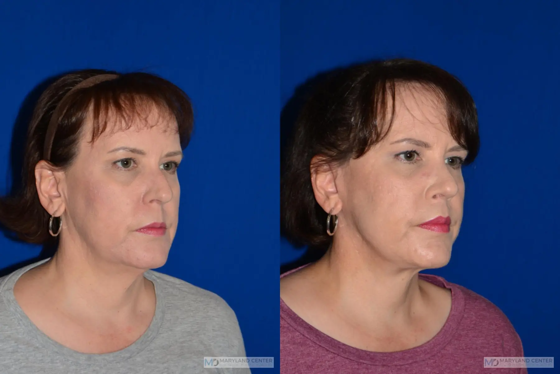 Facelift: Patient 3 - Before and After 3