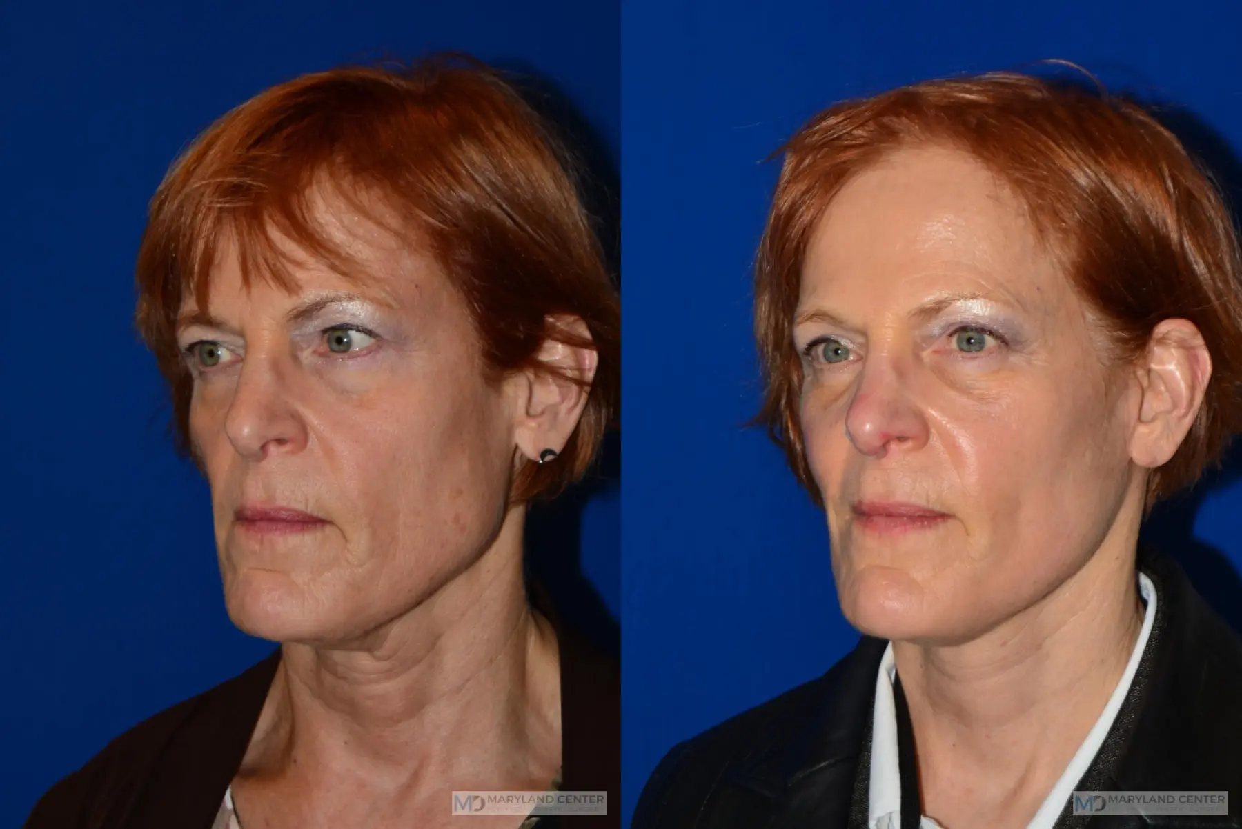 Facelift: Patient 4 - Before and After 2