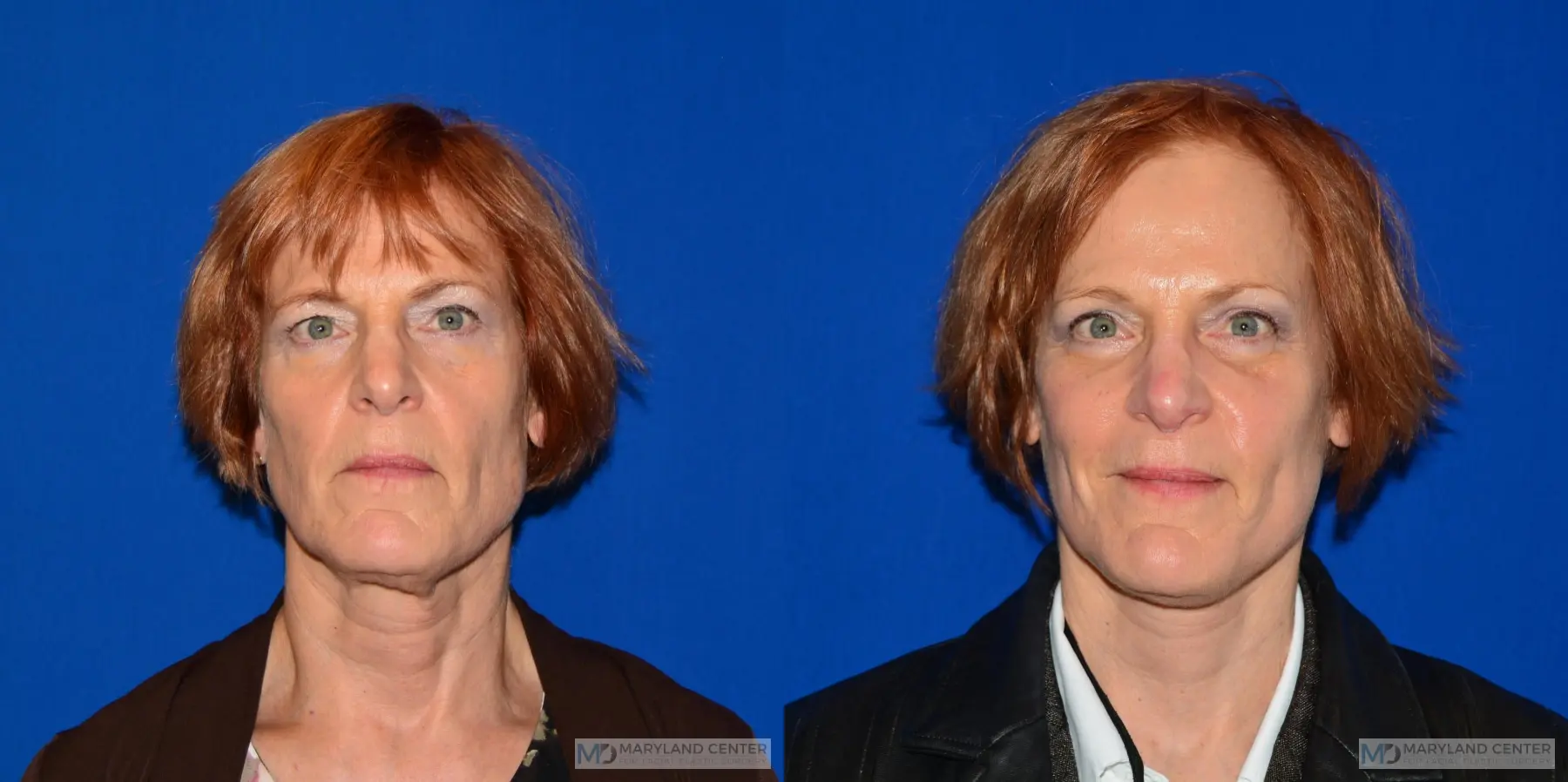 Facelift: Patient 4 - Before and After  