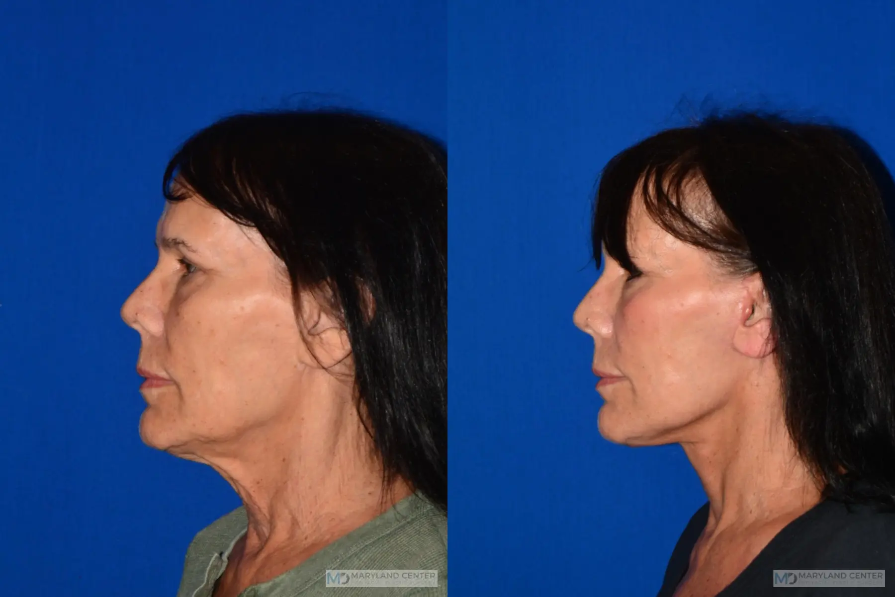 Facelift: Patient 1 - Before and After 4