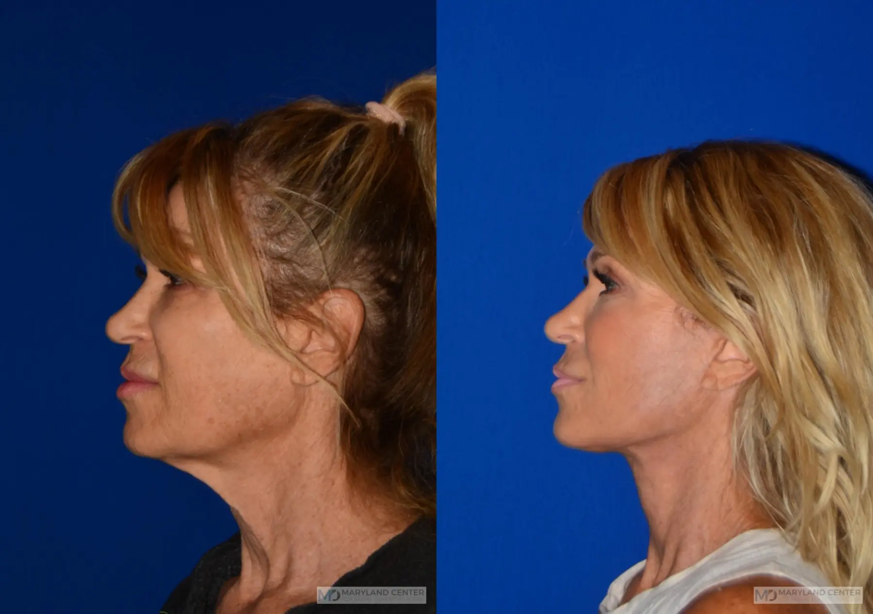 Facelift: Patient 1 - Before and After 4