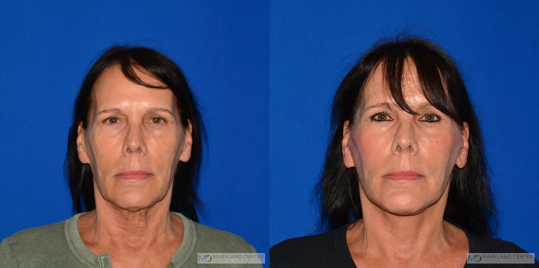 Facelift: Patient 1 - Before and After  