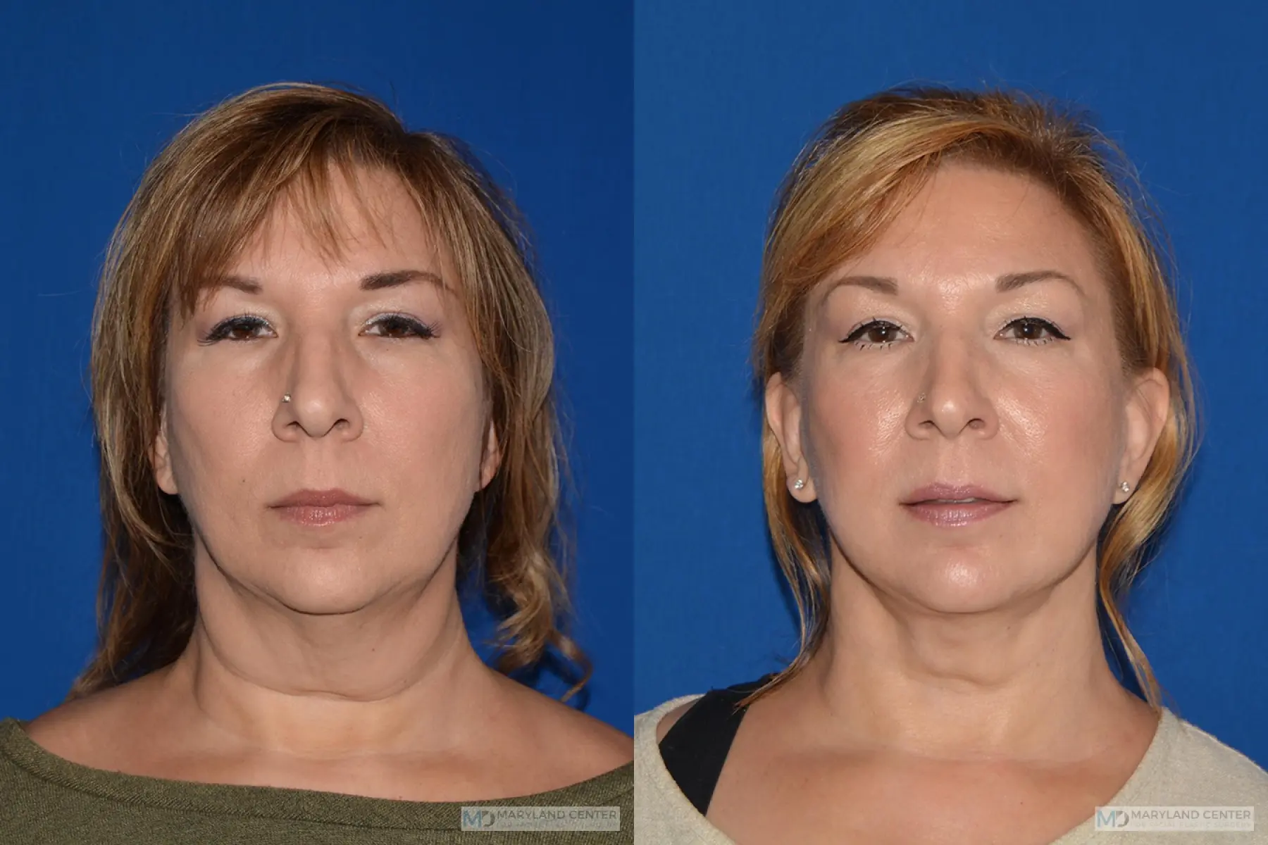 Facelift: Patient 2 - Before and After  