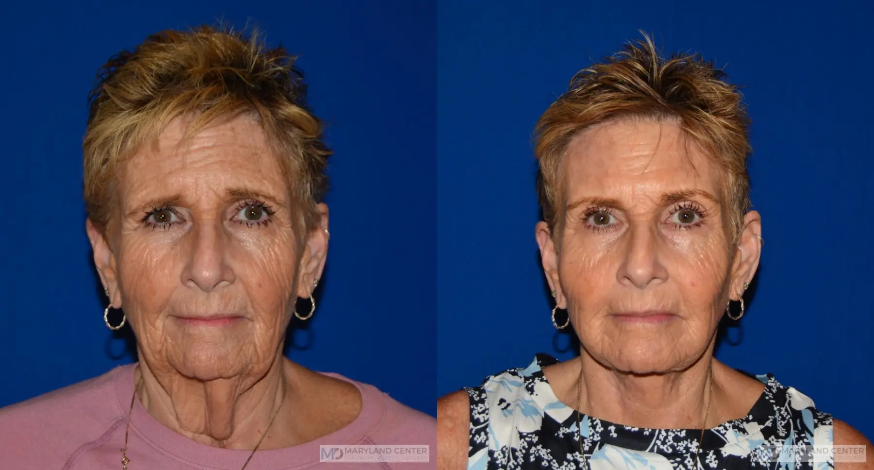 Facelift: Patient 6 - Before and After  