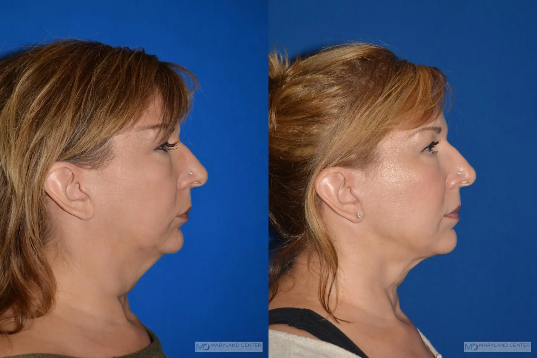 Facelift: Patient 2 - Before and After 2