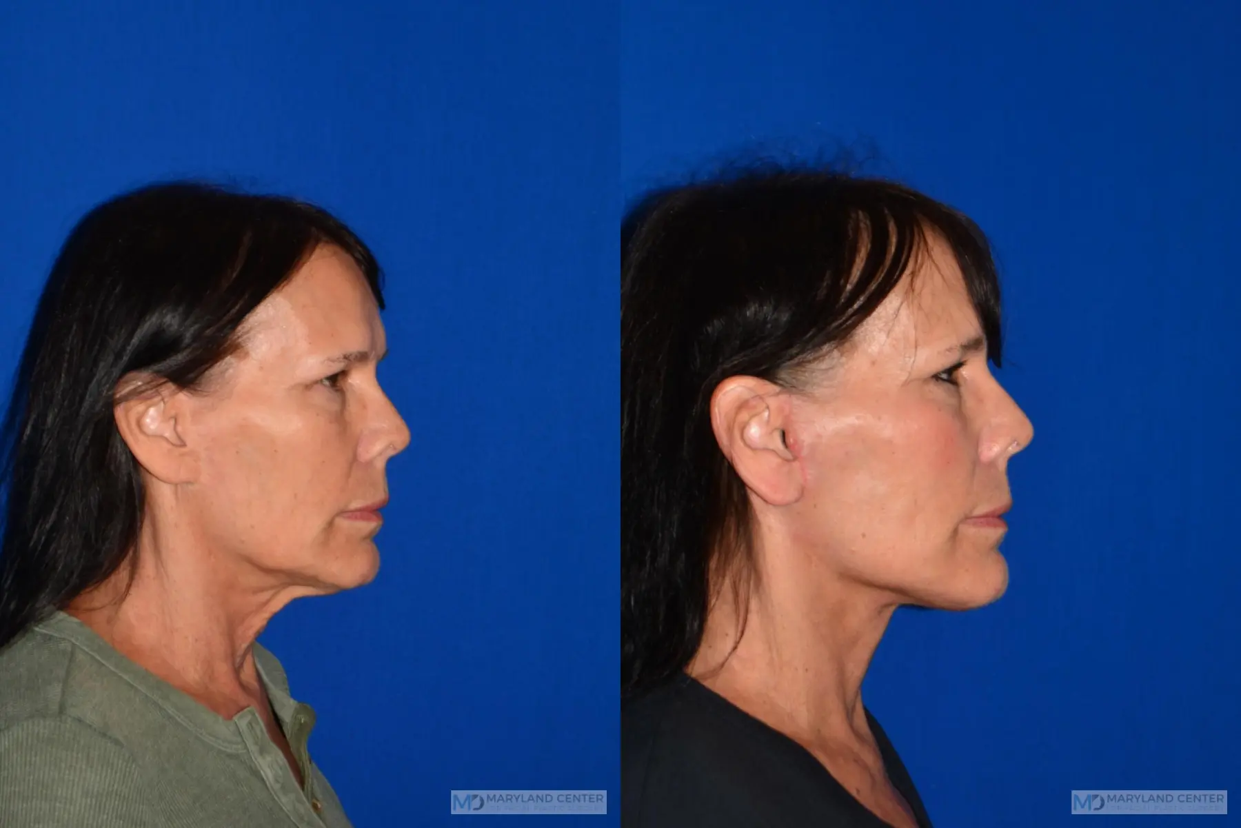 Facelift: Patient 1 - Before and After 2
