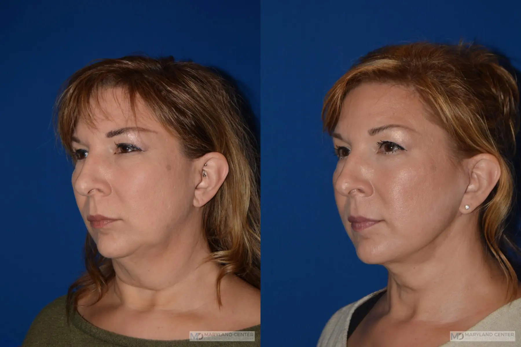 Facelift: Patient 2 - Before and After 5