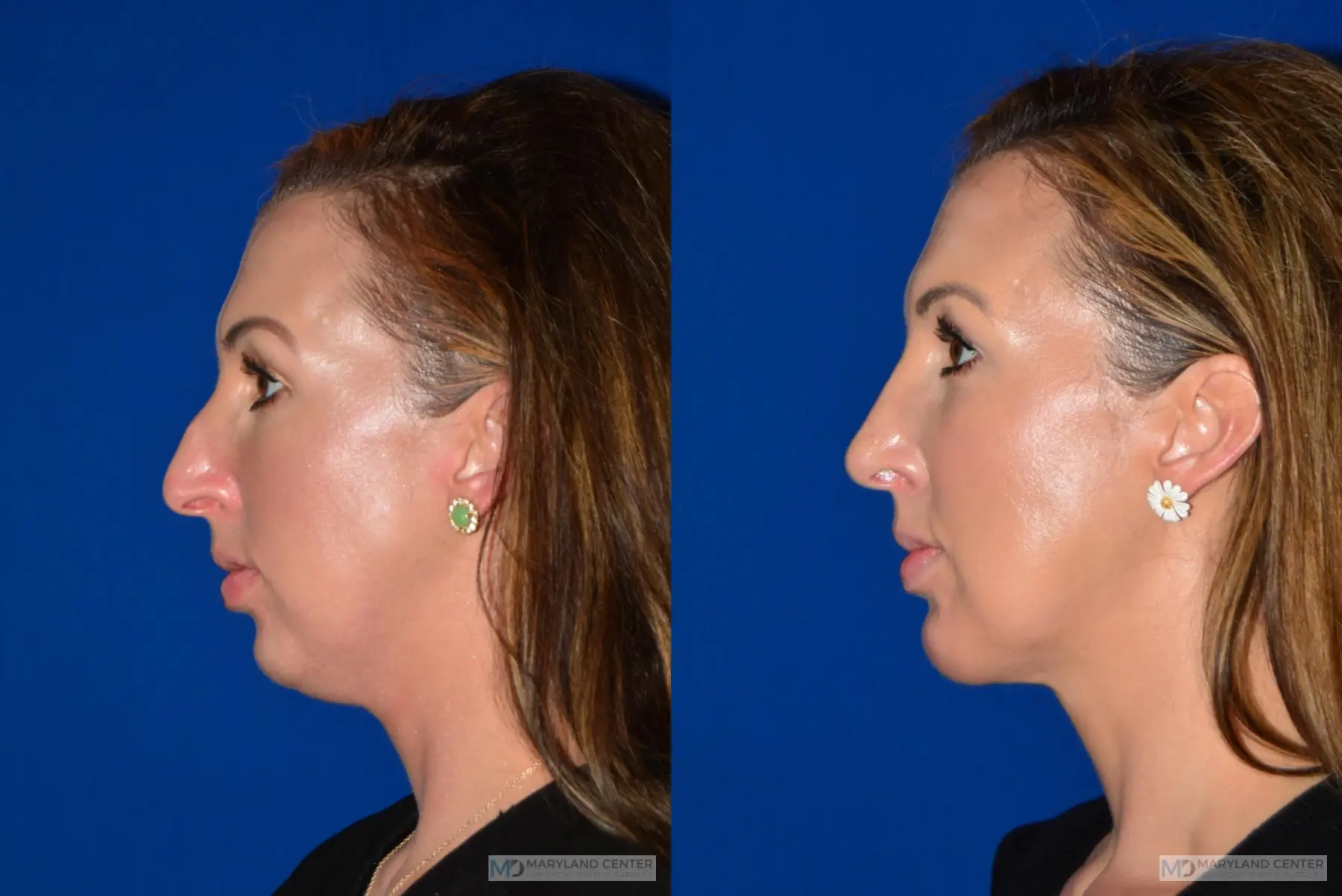 Facial Liposuction: Patient 2 - Before and After 2
