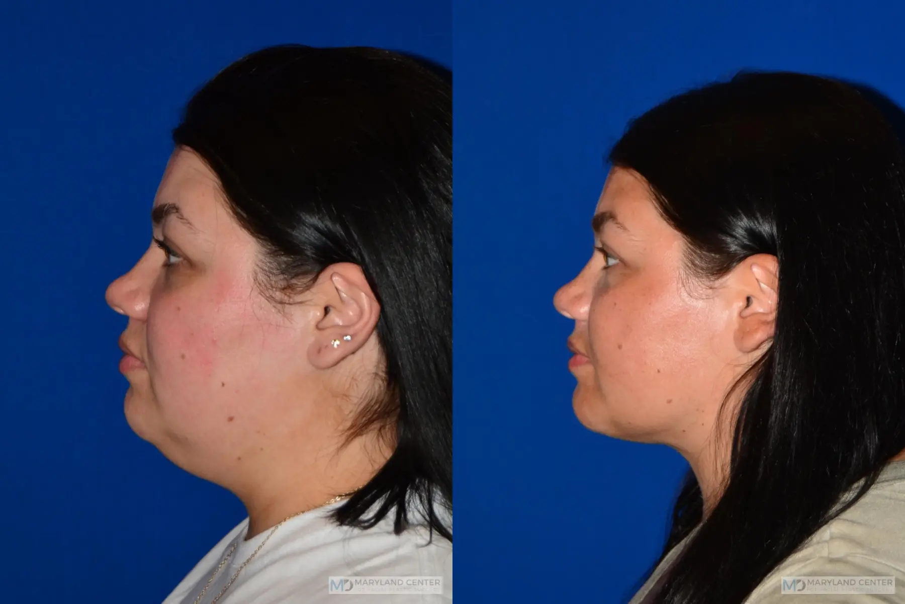 Facial Liposuction: Patient 3 - Before and After 2