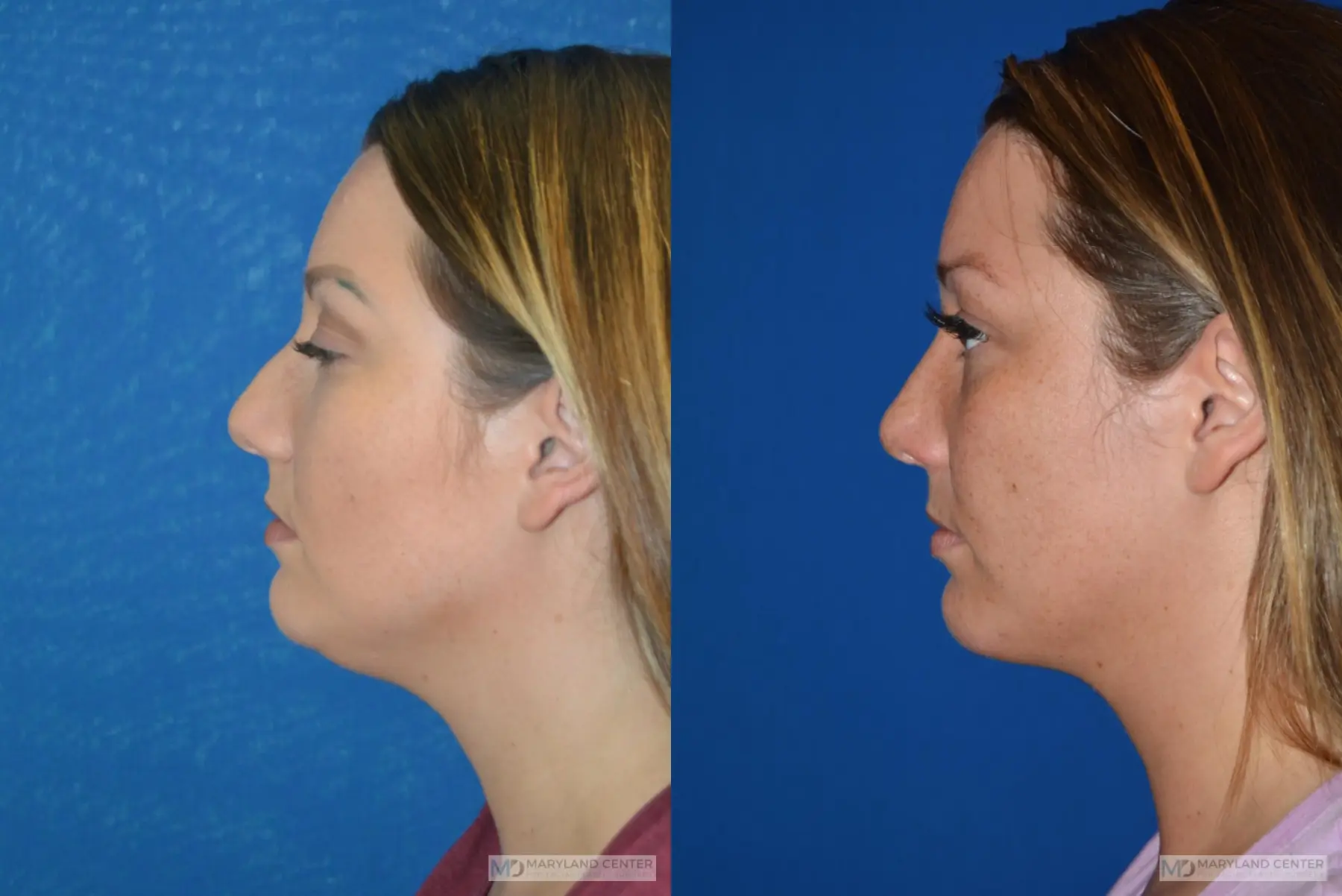 Facial Liposuction: Patient 4 - Before and After 2