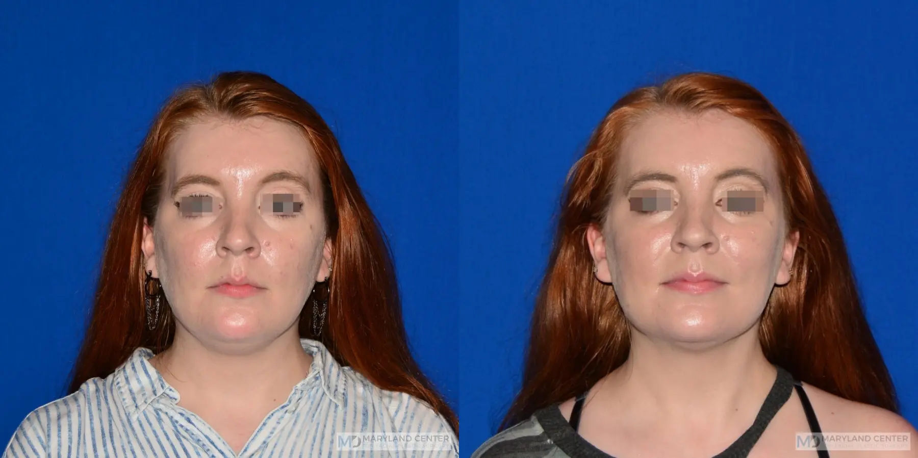 Facial Liposuction: Patient 5 - Before and After  
