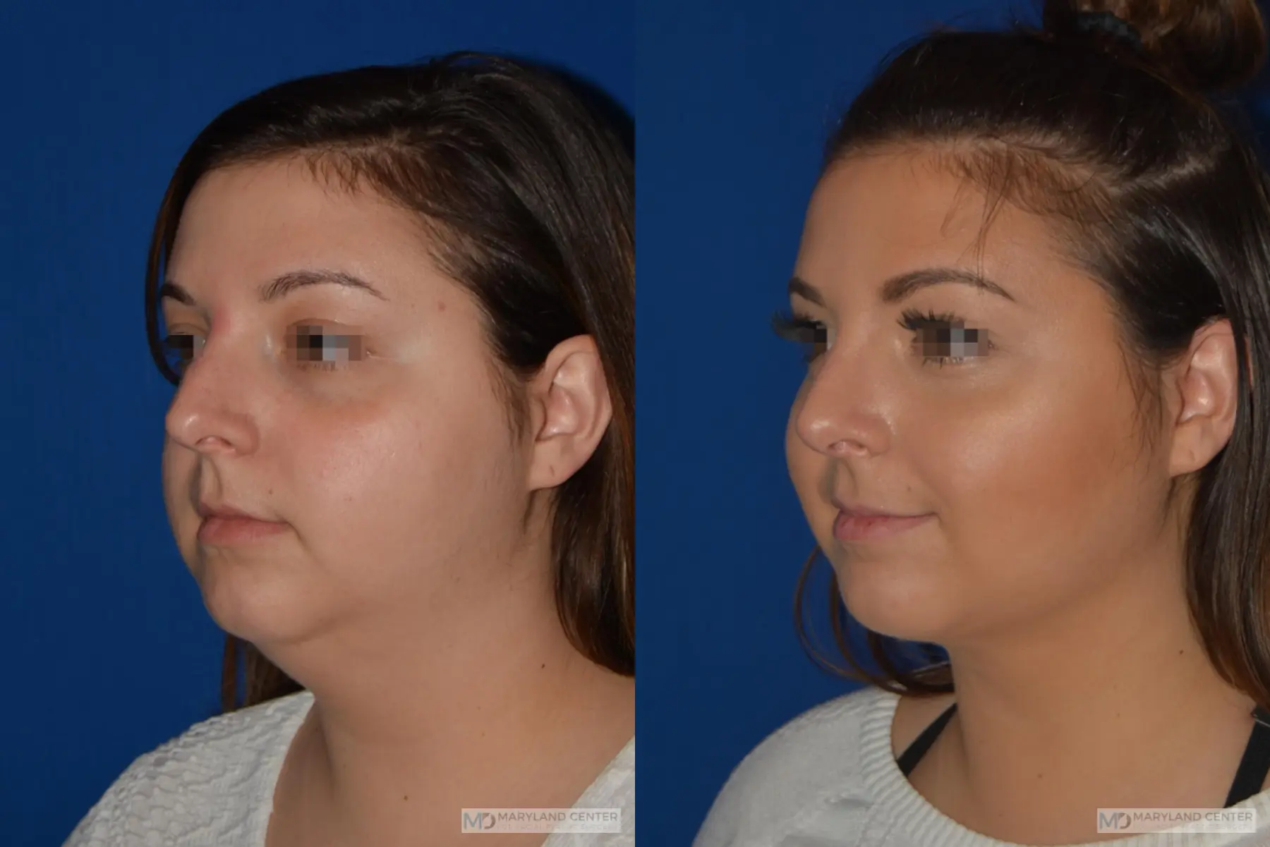 Facial Liposuction: Patient 1 - Before and After 3