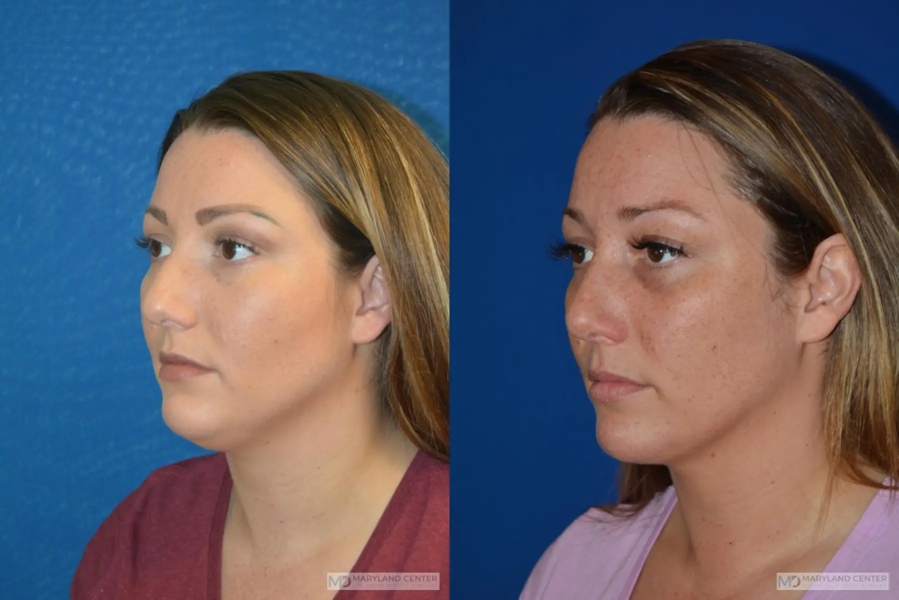 Facial Liposuction: Patient 4 - Before and After 3