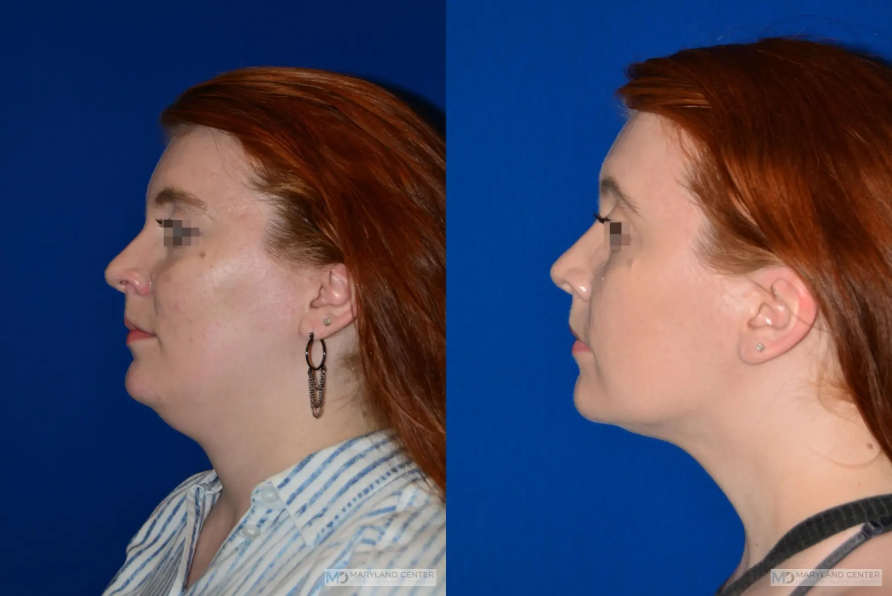 Facial Liposuction: Patient 5 - Before and After 2