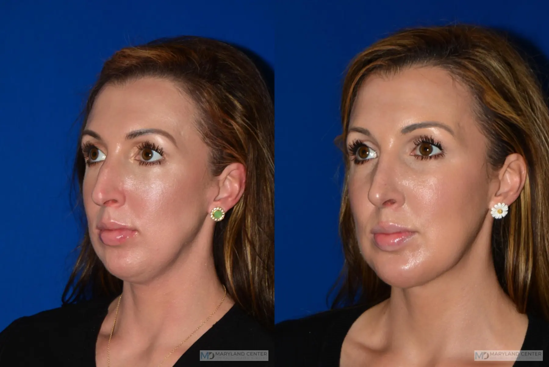 Facial Liposuction: Patient 2 - Before and After 3