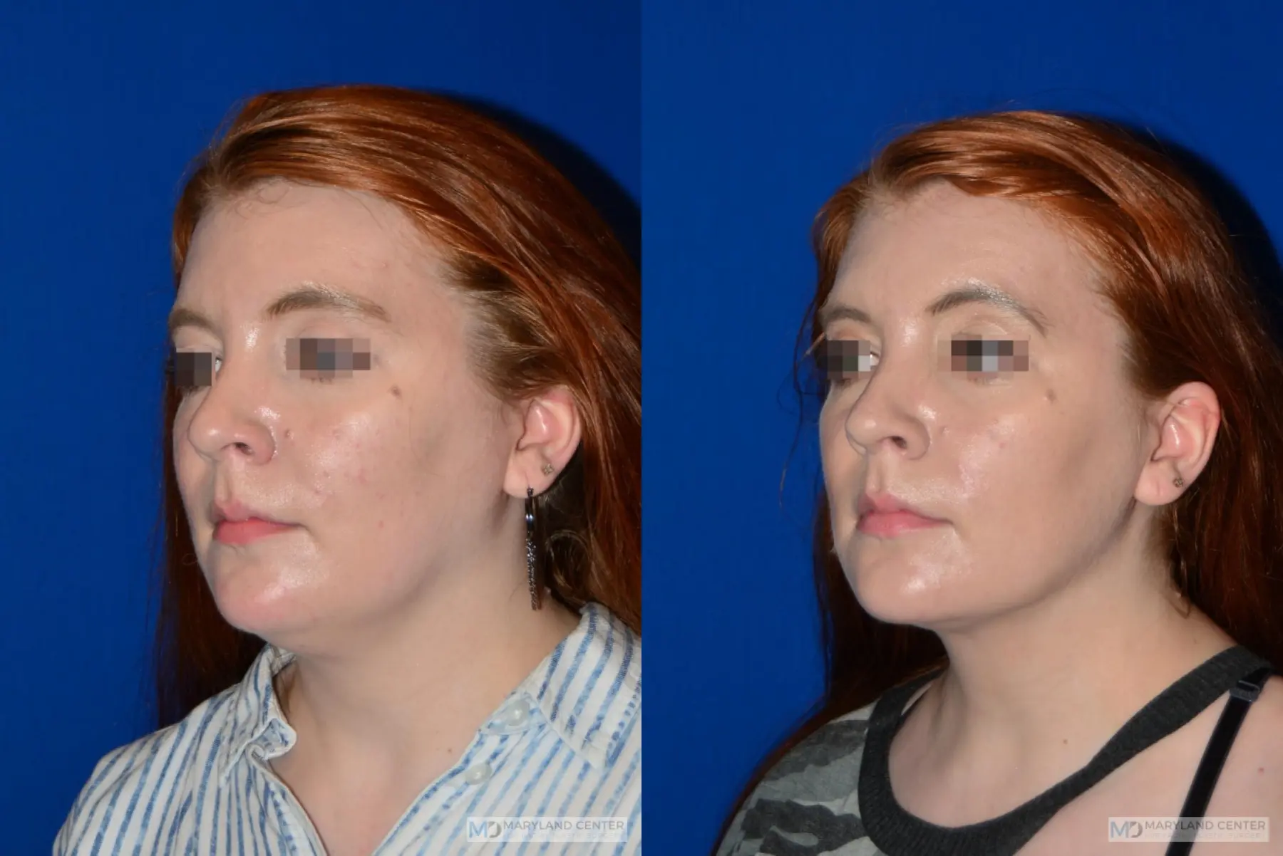 Facial Liposuction: Patient 5 - Before and After 3