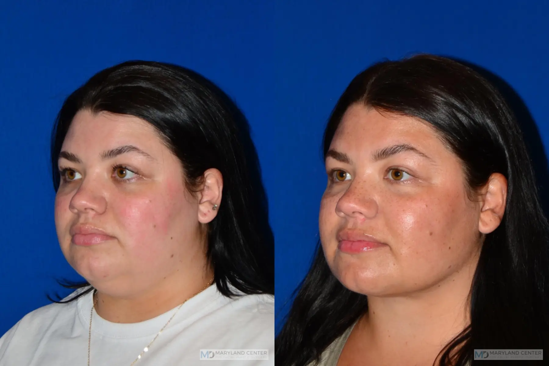 Facial Liposuction: Patient 3 - Before and After 3