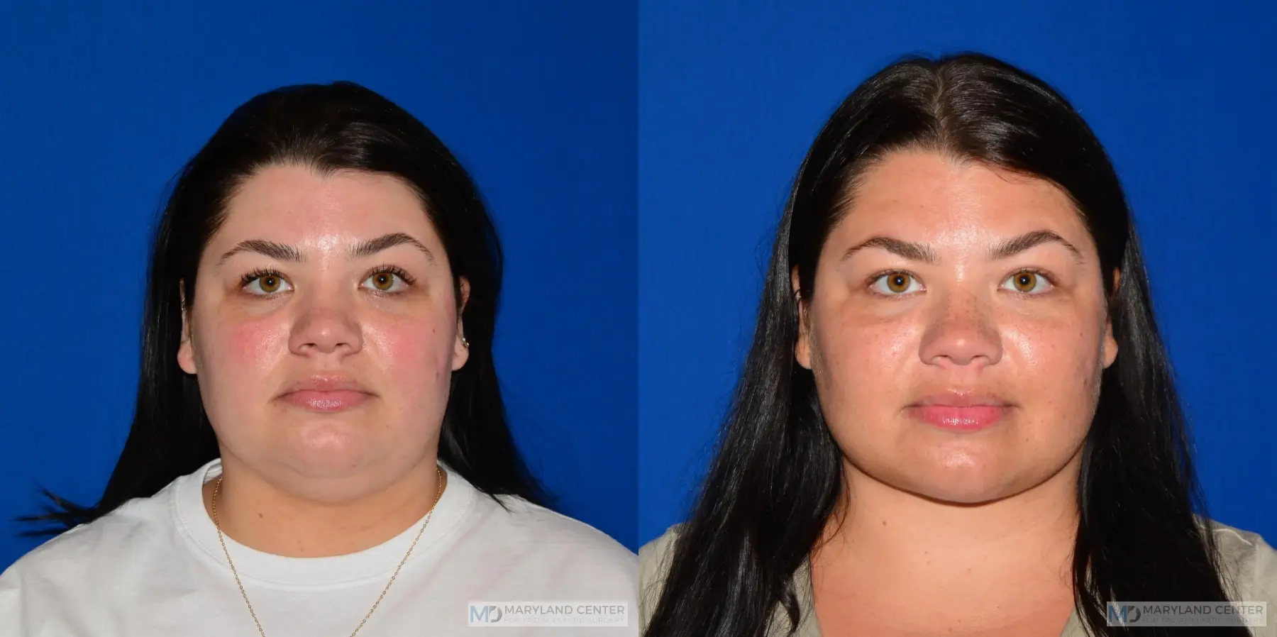 Facial Liposuction: Patient 3 - Before and After  