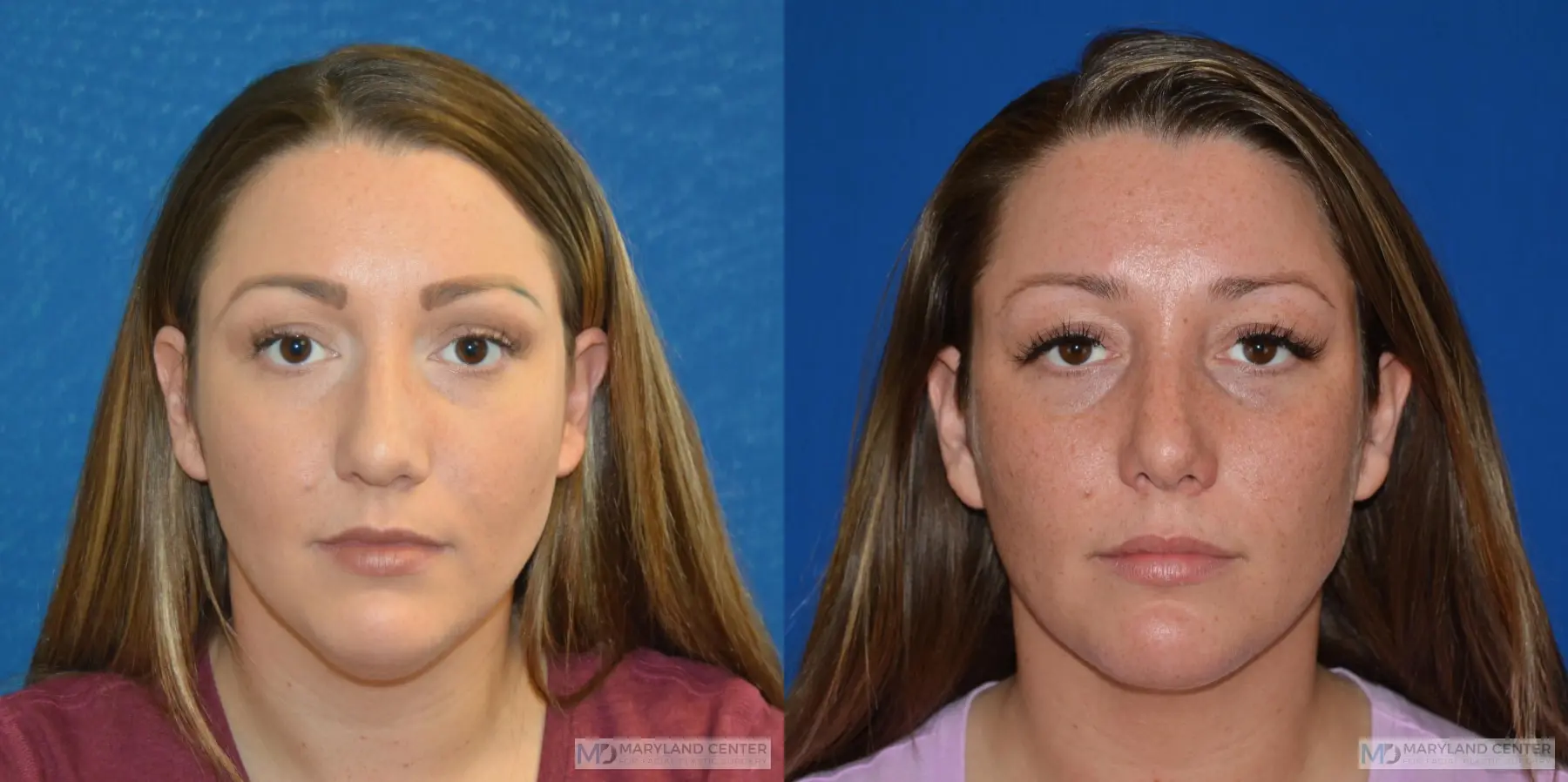 Facial Liposuction: Patient 4 - Before and After  