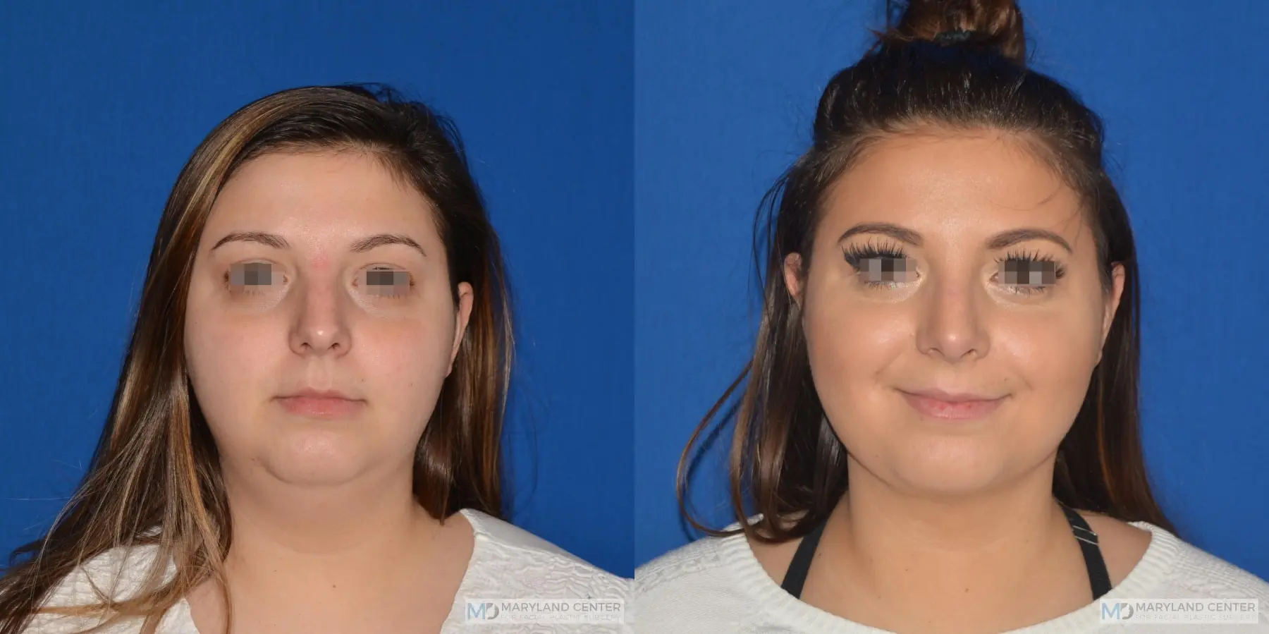 Facial Liposuction: Patient 1 - Before and After  