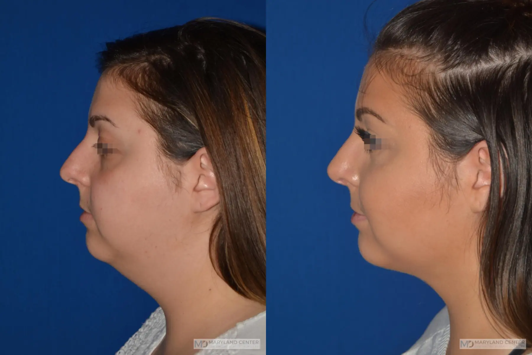 Facial Liposuction: Patient 1 - Before and After 2