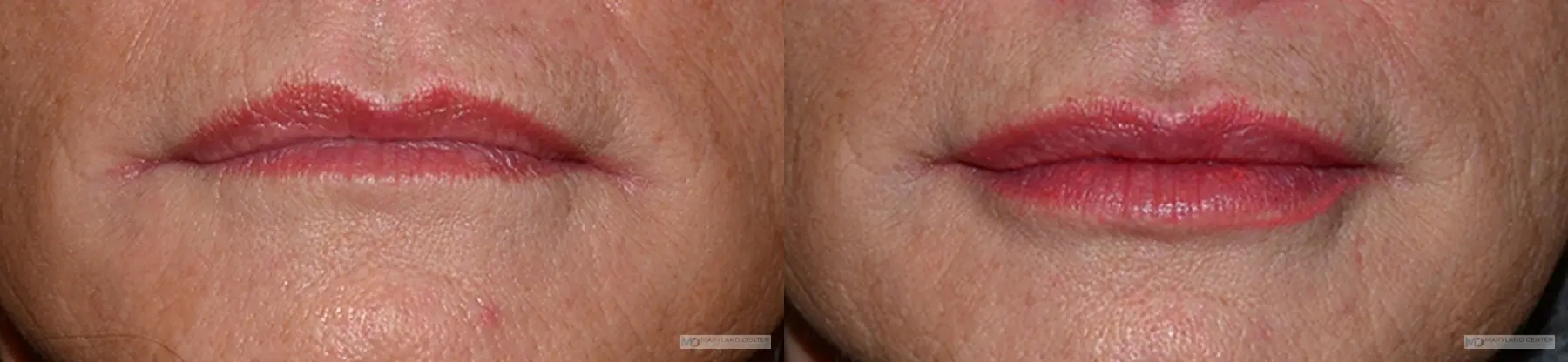 Injectables: Patient 1 - Before and After  