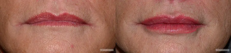 Injectables: Patient 1 - Before and After  